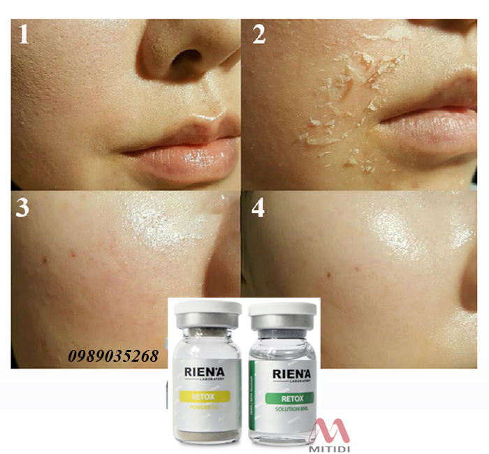 Vi kim tảo biển Retox  vi-kim-tao-bien-retox-riena-05.jpg (277 KB)